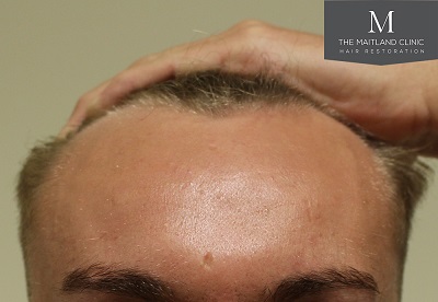 The Maitland Clinic hair transplant.jpg