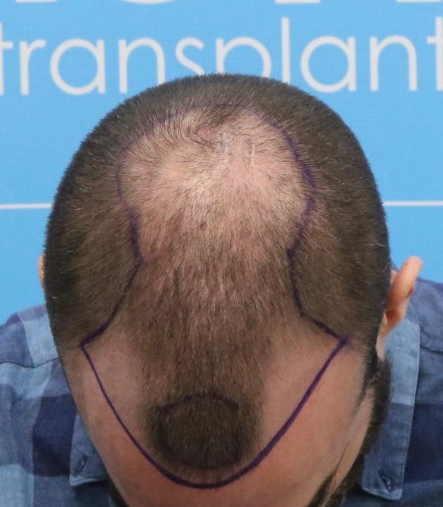 top of head 2 hair dr.jpg