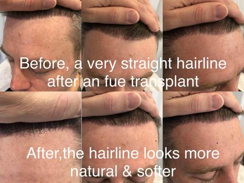 tricopigmentation-straight-hair-line.jpg