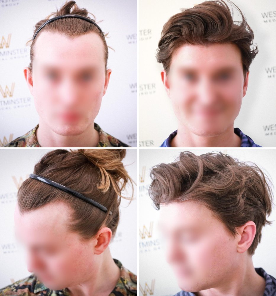 WMG Hair Transplant Result.jpg