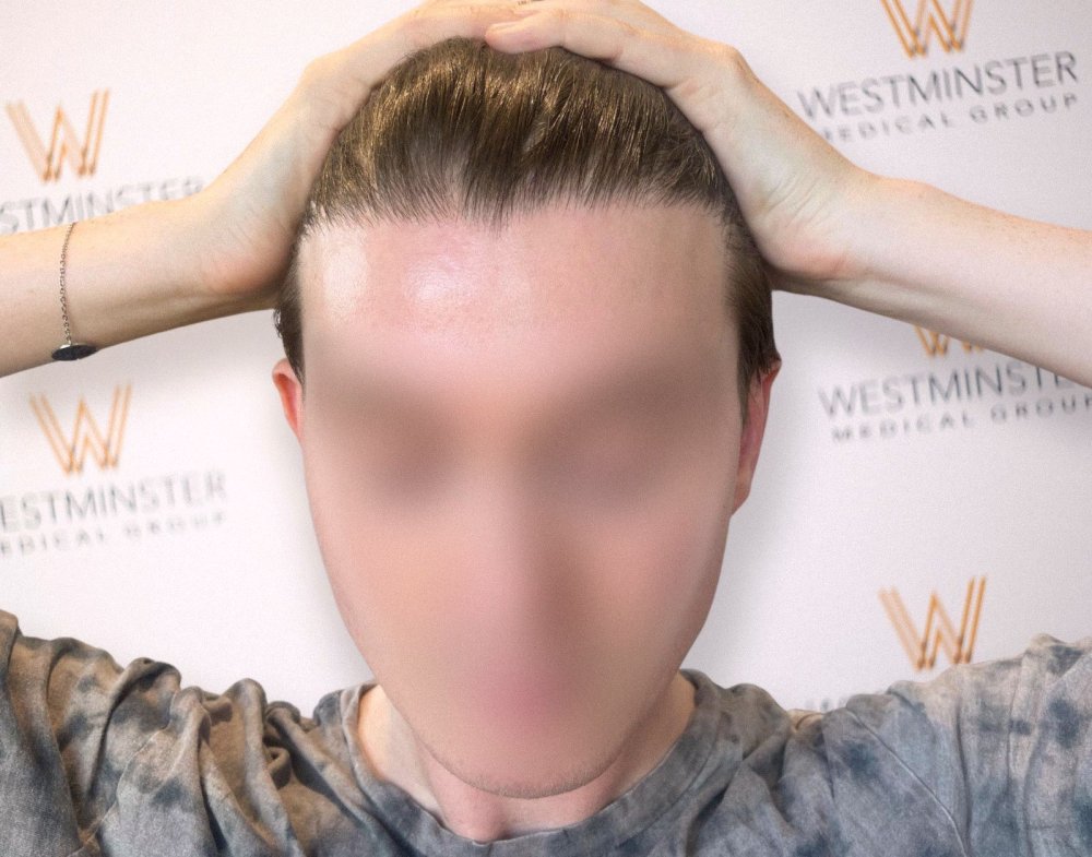 WMG Hairline Close Up.jpg