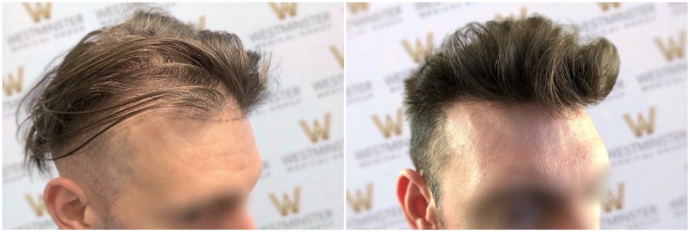 WMG London Hair Transplant.jpg