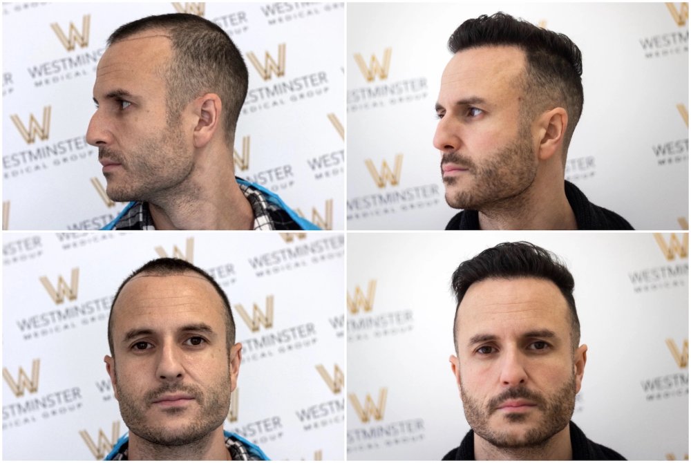 Westminster Medical Group London - 1528 Grafts - 12 Month Result | Hair ...