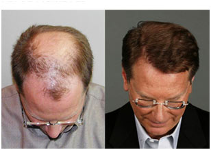 ACHIEVING DENSITY IN HAIR TRANSPLANTATION UNDERSTANDING-2