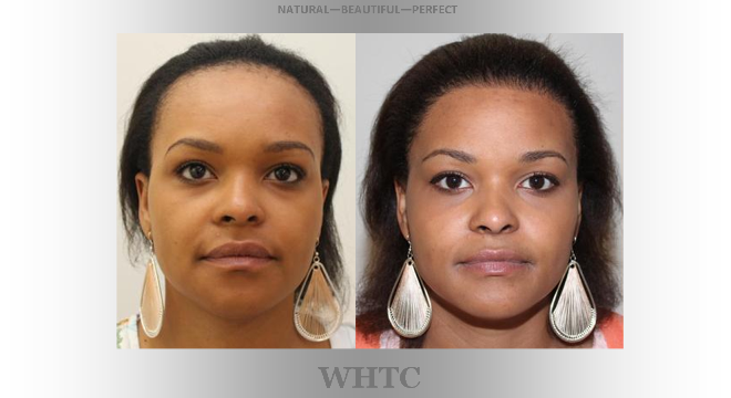 FEMALE HAIR LINE HAIR TRANSPLANT 4photoslide_zpsbff8fdfd