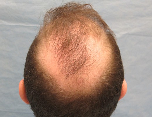 HAIR TRANSPLANT IN THE CROWN crown_early-transplant