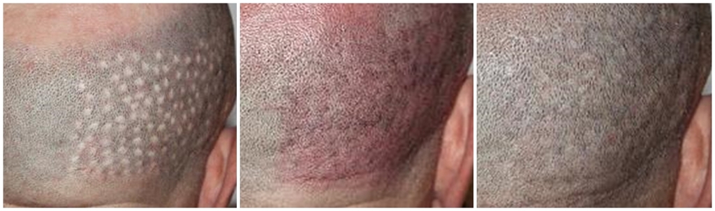 Large hair transplant punch scars (plugs) repaired with Scalp Micropigmentation smp