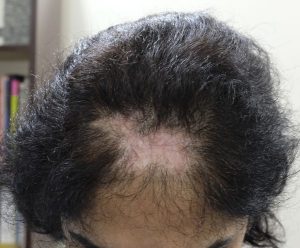 Necrosis after a hair transplant