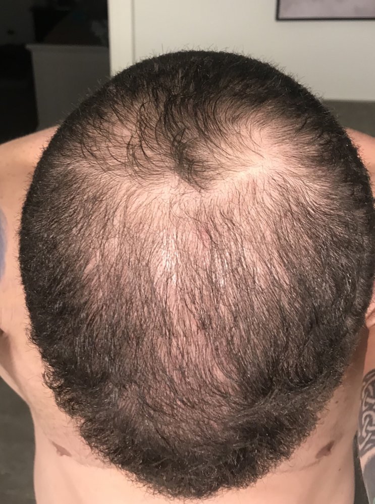 Diffuse thinning Rx minoxidil and finasteride  WRassmanMD BaldingBlog