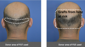 Should I get a hair transplant? What are the risks?