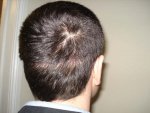 5 wks post op no 4 cut.JPG
