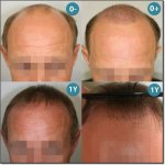 HAIR-TRANSPLANT-SURGERIES-200.jpg