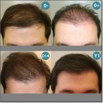 HAIR_TRANSPLANT_PATIENT-23-300.jpg