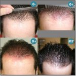 CORRECTION-HOMME-LIGNE-ANTERIEURE_200.jpg