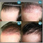 CORRECTION-HOMME-LIGNE-ANTERIEURE_300.jpg
