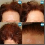 WOMEN-HAIR-DENSITY-300.jpg