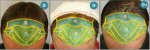 _CORRECTION_ANTERIOR_LINE (2).jpg