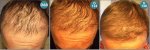 _CORRECTION_ANTERIOR_LINE (6).jpg
