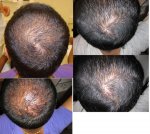 prp na 2 maanden.jpg