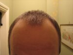 frontal showing forehead and hair outline..jpg