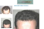NeoGraft4 FRONT of head.JPG