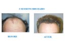 NeoGraft 5 FRONT of head.JPG