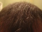 7 month front behind hairline.jpg