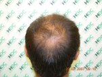 Before Crown.JPG