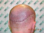 3rd day strip Donor.JPG