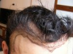 Hairline Before.JPG