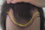 hairline HLE.jpg