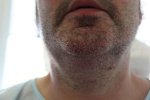 post op chin 1.JPG