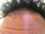 18 Months Post-Op Pimple Day 1.jpg