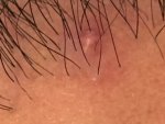 18 Months Post-Op Pimple Day 2.jpg