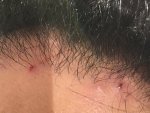 11 months Post-Op Pimples blood.jpg