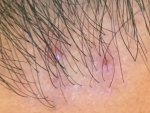 18 Months Post-Op Pimple Day 3.jpg
