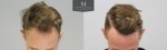 ID719-Before-after_front_tilt.jpg