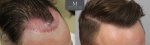 ID719-Before-after_right45_graft-placement.jpg