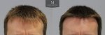 1878 Grafts FUE, The Maitland Clinic, Dr Edward Ball, 9 month post op, double, Front.jpg