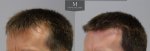 1878 Grafts FUE, The Maitland Clinic, Dr Edward Ball, 9 month post op, double, left 45.jpg