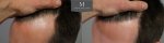1878 Grafts FUE, The Maitland Clinic, Dr Edward Ball, 9 month post op, double, Left 45 close.jpg