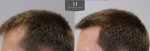 1878 Grafts FUE, The Maitland Clinic, Dr Edward Ball, 9 month post op, double, Left.jpg