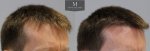 1878 Grafts FUE, The Maitland Clinic, Dr Edward Ball, 9 month post op, double, Right 45.jpg