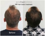 dieter v hair boost crown area.jpg dieter v hair boost crown area.jpg