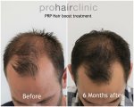 dieter v hair boost frontal area.jpg dieter v hair boost frontal area.jpg