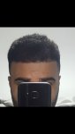 Fue Hair Transplant 5 months..jpg