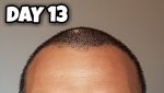 Day 13 Hairline.jpg Day 13 Hairline.jpg