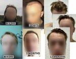4000 Grafts.jpg