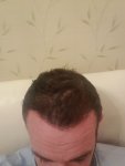 Dr Bisnaga hair transplant 1.jpg