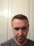 Dr Bisnaga hair transplant 5.jpg